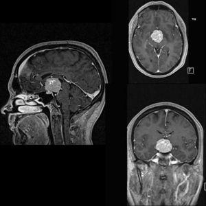 Pituicitoma Hipofisario | Neurología Argentina