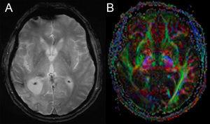 Infarto Cerebral Secundario A Anomalia Del Desarrollo Venoso En Un Paciente Oncologico Neurologia Argentina