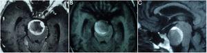 Resonancia magnética-T1 en corte axial (A y B) y sagital (C) que muestra un aneurisma gigante con compresión del puente encefálico en su porción ventral.