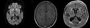Hallazgos en la imagen de la resonancia magnética (IRM) de encéfalo: A) Paciente 2: IRM de control 30 días posterior. B) Paciente 3: IRM de ingreso. C) Paciente 5: IRM de ingreso.