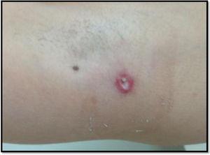 Lesión axilar después de cuatro días de tratamiento antibiótico.
