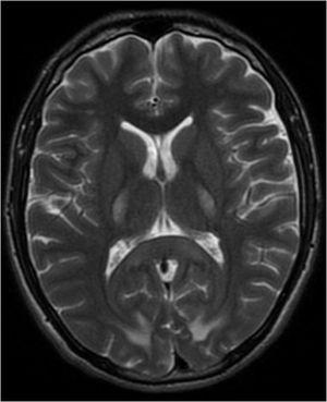 Resonancia magnética de cerebro simple, corte axial, T2. Zonas hiperintensas bilaterales simétricas en brazos posteriores de cápsulas internas y en lóbulos occipitales. Aumento de las cisuras cerebrales.