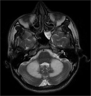 Resonancia magnética de cerebro simple, corte axial, T2. Zonas hiperintensas simétricas bilaterales en hemisferios cerebelosos, y sinusitis etmoidal.
