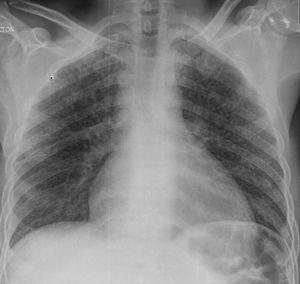 Radiografía de tórax: Opacidades de tipo reticulonodulillar que presentan una distribución difusa en ambos campos pulmonar relacionadas con un patrón “miliar”.
