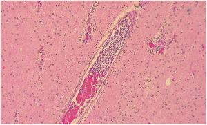 Anatomía patológica de vaso sanguíneo cerebral. Vaso de mediano calibre cerebral con presencia de abundantes células tumorales en su interior con morfología de linfocitos B.