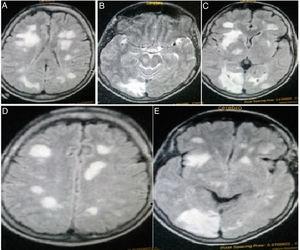 RM encefálica (en A, C-E: secuencia FLAIR; en B: secuencia T2): Se observan lesiones multicéntricas a nivel supratentorial, bilaterales, que se manifiestan como procesos hiperintensos y heterogéneos. Son lesiones voluminosas y en algunos sectores, confluentes. Las de mayor tamaño se ubican a nivel subcortical, frontal bilateral, occipital derecho y en centros semiovales. El tronco encefálico muestra lesiones a nivel de pedúnculos cerebelosos.