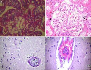 A y B) Biopsia renal: (coloración: hematoxilina eosina; número de ampliación en A: ×60; en B: ×40). Se observa cuadro histomórfico compatible con endoteliosis glomerular y signos de mesangiolisis (dilatación capilar). Proliferación linfoide intravascular con infiltrado inflamatorio intersticial mononuclear de carácter inespecífico. Atrofia tubular focal que no supera el 15% de la muestra y vasos arteriolares sin lesión. Se interpreta como lesión de injuria endotelial con significativa endoteliosis, no trombótica vs linfoma intravascular. C y D) Biopsia encefálica: (coloración: Giemsa; número de ampliación en C: ×10; en D: ×40). Se observa proliferación celular endocapilar, se plantea como primera hipótesis diagnóstica: linfomatosis intravascular (angioendoteliomatosis proliferante). Inmunohistoquímica: estirpe linfoide de elementos endovasculares, consistente con la sospecha de linfoma b de células grandes intravascular, CD20+.
