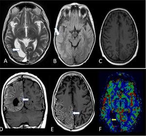 RM cerebral al día siguiente. Las imágenes en T2 (A) y FLAIR (B), alrededor de la cavidad de resección occipital derecha, muestran un marcado engrosamiento cortical posterior temporal, parietal y occipital, y un aumento de la señal en T2 (flechas blancas). La imagen en T1 sin contraste (C) no muestra realce cortical. Las imágenes poscontraste de T1 (D y E) muestran un marcado realce de predominio cortical en asociación con regiones de engrosamiento cortical (flechas blancas). En el mapa de volumen sanguíneo de perfusión (F), el realce cortical no se asocia con un cambio significativo en la perfusión cerebral, solo se observa congestión en los vasos piales de la región parietal (flecha blanca).