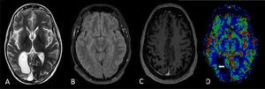 RM cerebral a los 6 meses: en T2 axial (A), FLAIR (B) y T1 poscontraste (C), con resolución del engrosamiento cortical, y del realce que rodea la cavidad de resección. El volumen cerebral de perfusión (D) es relativamente simétrico (flecha blanca).