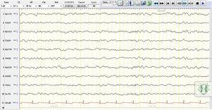Electroencefalograma (EEG): montaje para muerte cerebral. Actividad theta y delta generalizada, continua de baja amplitud, sin actividad epileptiforme.