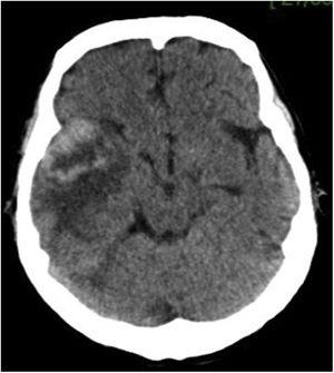 TC cerebral que muestra imagen heterogénea, temporo-parietal derecha, de 44×47mm, con refuerzo del contraste y edema perilesional.