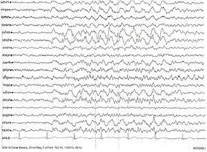 Registro electroencefalográfico en vigilia con presencia de ritmo delta intermitente frontal.