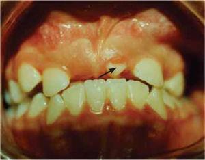 En la máxima intercuspidación se observa el diente en mordida cruzada.