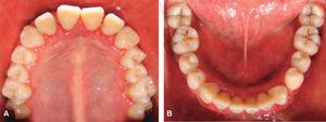 Fotografías clínicas de arcada superior (A) e inferior (B) sin rehabilitación bucal.