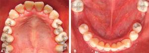 Fotografía clínica de arcada superior (A) e inferior (B) con reha A B bilitación bucal.