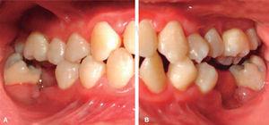 Fotografía clínica lateral derecha (A) e A B izquierda (B) con rehabilitación bucal.