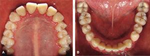 Clinical pictures of upper arch (A), lower arch (B) without oral rehabilitation.