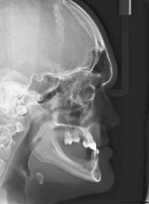 Radiografía lateral que muestra la ausencia de procesos alveolares en la región desdentada de los maxilares superior e inferior.