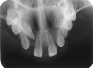 Raios X oclusais dos maxilares superiores mostrando a colocação dos dentes presentes no arco.