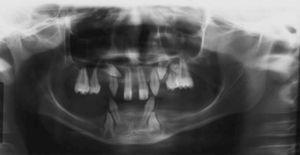 Radiografía panorámica característica de HED que muestra la ausencia de dientes múltiples con presencia de 11 dientes superiores y sólo 4 inferiores, así como alteraciones de la forma de las coronas y las raíces.