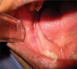Intra-oral clinical photograph of hyperemic lesion with presence of fistula.