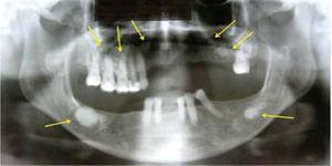 Sinus dental orthopantomography showing multiple circumscribed circular radio-opaque images involving all four quadrants (arrows). At the right mandibular body a radio-opaque image can be observed surrounded by a radio-lucid area which extends into all the basal portion of the lesion, compatible with an infectious process.