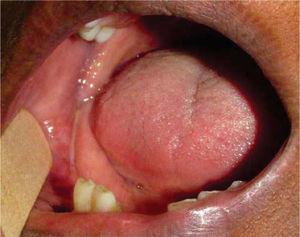 Intraoral clinical photograph showing lack of volume increase or color change at the level of the mucosa.