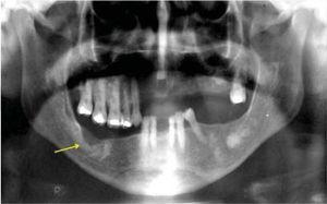 Dental sinus orthopantomography revealing operated area with suitable bone regeneration (arrow) as well as remaining lesions without size changes.