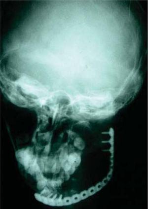 Vista radiográfica da prótese reconstrutiva mandibular con preservación de Confilo despois da resección de ameloblastoma.