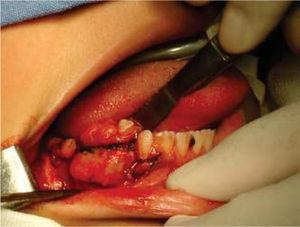 Excisão de bloco cirúrgico de fibroma ameloblástico mandibular.