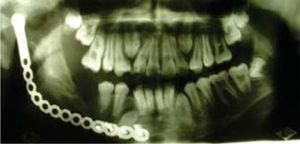 Vista radiográfica exhibindo neoformación ósea mandibular seguinte ao contorno da placa de reconstrución de titanio.