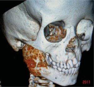 Tomografia a destra mandibolare osteoblastoma 3-D.