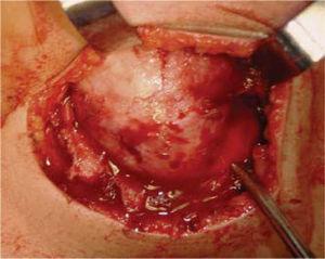 aspect chirurgical de ostéoblastome mandibulaires droit résection.