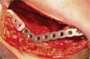 próteses mandibulares com côndilo após hemi-mandibulectomia direita.