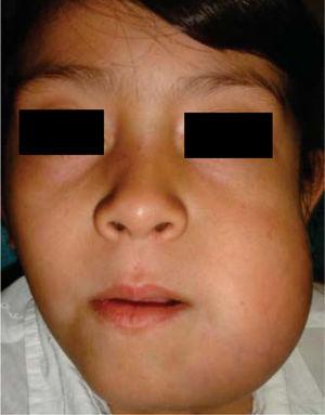 Aparência facial com uma evolução de cinco meses do ameloblastoma mandibular direito .