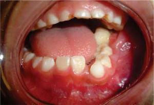 Vista oral intra dun evolución de cinco meses de evolución Mandibular Ameloblastoma.