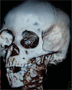 tomografia 3D de ameloblastoma esquerda esquerda, com Preservação de apófise e côndilos coronóides.