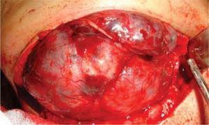 Aspect chirurgical al ameloblastomului mandibular drept, cu conservarea nervului dentar inferior.