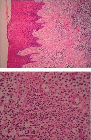 (HE 5x) Acanthic epithelium, pseudoerpithelimatous hyperplasia, lamina propria, apparent vascular canals and inflammatory infiltrate. (HE 10x) Canaux vasculaires recouverts de cellules endothéliales, infiltrat inflammatoire composé de lymphocytes, de plasmocytes, d'histiocytes et de polymorphes nucléaires occasionnels.