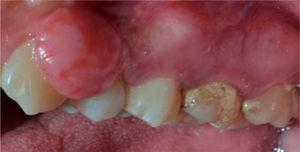 Front view of the gingival lesion, located at the level of teeth 2.3 and 2.4.