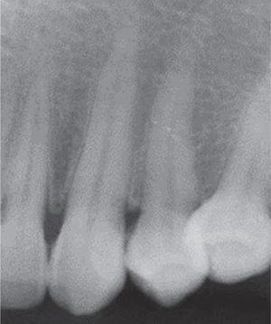 Periapical X-ray, lack of bone loss.