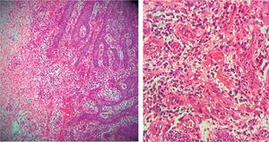 Pseudoepithelial hyperplasia and granulation tissue, vascular canals coated with endothelium and erythrocyte ingurgitation, inflammatory infiltrate with histiocyte and neutrophil predominance.