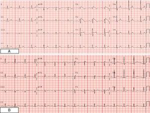 Hyperkalemia Mimicking A Pattern Of Brugada Syndrome 