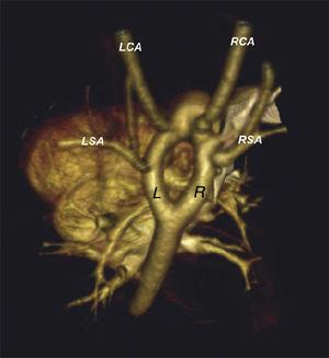 interrupted aortic arch type c collateral vessels