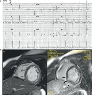 A: ECG from individual III.1. B: Left ventricle short axis cardiovascular magnetic resonance images from individual III.1.