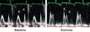 Mitral flow at rest (A) and after exercise (B) in patients with a prolonged isovolumetric relaxation pattern at rest, which becomes pseudonormal during exercise, eith an inverted E/A ratio.