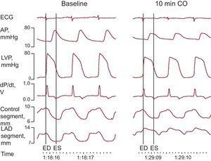 Example of electrocardiogram, hemodynamic, and segment length monitoring at baseline and 10min following coronary occlusion. AP, arterial pressure; CO, coronary occlusion; dP/dt, first derivative of LVP; ECG, electrocardiogram; ED, end-diastole; ES, end-systole; LAD, left anterior descending coronary artery; LVP, left ventricular pressure.