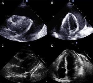 Example of a severe circumferential malignant pericardial effusion treated by percutaneous balloon pericardiotomy (patient 5) and follow-up at 8 months with no new procedures. A and B: Parasternal and apical views showing the severe malignant effusion (40 mm) before treatment with percutaneous balloon pericardiotomy. C and D: Parasternal and apical views at 8 months, in which only a very small pericardial effusion is seen.