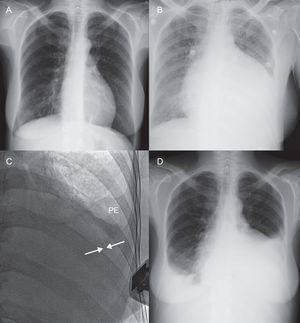 Radiologic evolution following percutaneous balloon pericardiotomy (patient 14). A: Chest x-ray performed 2 months previously shows no significant pathology findings. B: 1 day before percutaneous balloon pericardiotomy, a considerable increase in the cardiothoracic index was observed. C: Following the procedure, fluoroscopy and echocardiography demonstrate persistence of a very small pericardial effusion (arrows), with a small amount of pleural effusion occupying the left costophrenic sinus. D: At 48 h, there is a marked increase in left and right pleural effusion and the cardiothoracic index remains increased; at this time there was a severe pericardial effusion, although smaller than before the procedure. PE, pleural effusion.