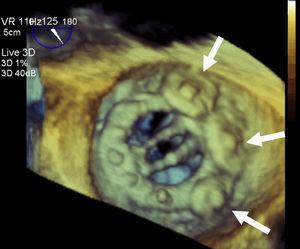 Three-dimensional transesophageal echocardiography in structural intervention. The image shows a mechanical mitral valve from the atrial side, with three closure devices (arrows) deployed to treat a perivalvular leak.